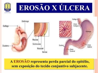 A EROSÃO representa perda parcial do epitélio,
sem exposição do tecido conjuntivo subjacente.
EROSÃO X ÚLCERA
 