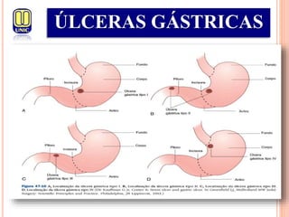 ÚLCERAS GÁSTRICAS
 