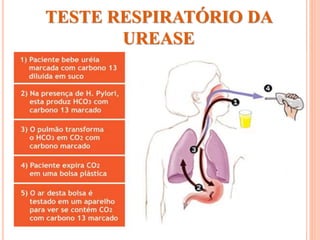 TESTE RESPIRATÓRIO DA
UREASE
 