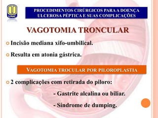 PROCEDIMENTOS CIRÚRGICOS PARAA DOENÇA
ULCEROSA PÉPTICA E SUAS COMPLICAÇÕES
VAGOTOMIA TRONCULAR
 Incisão mediana xifo-umbilical.
 Resulta em atonia gástrica.
 2 complicações com retirada do piloro:
- Gastrite alcalina ou biliar.
- Síndrome de dumping.
VAGOTOMIA TROCULAR POR PILOROPLASTIA
 