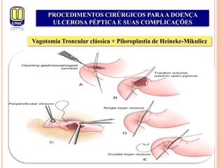 PROCEDIMENTOS CIRÚRGICOS PARAA DOENÇA
ULCEROSA PÉPTICA E SUAS COMPLICAÇÕES
Vagotomia Troncular clássica + Piloroplastia de Heineke-Mikulicz
 