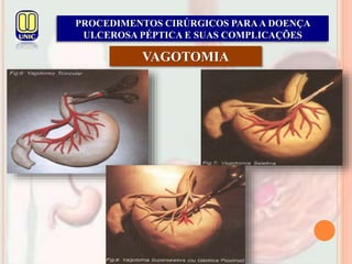 PROCEDIMENTOS CIRÚRGICOS PARAA DOENÇA
ULCEROSA PÉPTICA E SUAS COMPLICAÇÕES
VAGOTOMIA
 