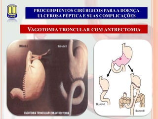 PROCEDIMENTOS CIRÚRGICOS PARAA DOENÇA
ULCEROSA PÉPTICA E SUAS COMPLICAÇÕES
VAGOTOMIA TRONCULAR COM ANTRECTOMIA
 