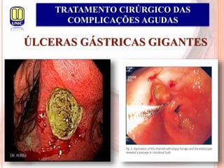 ÚLCERAS GÁSTRICAS GIGANTES
TRATAMENTO CIRÚRGICO DAS
COMPLICAÇÕES AGUDAS
 