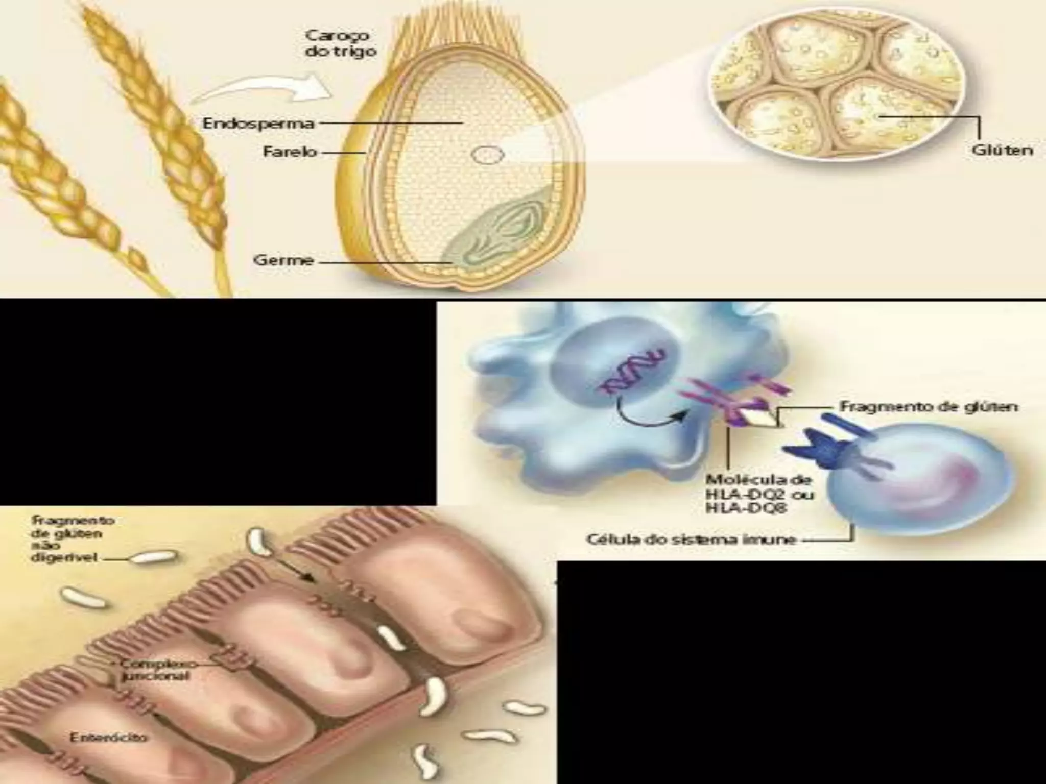 GliadinaETIOPATOGENIAtTGauto-antígeno envolvido - a transglutaminase tecidual  (enzima IC presente no endomisio)Complexos Gliadina-tTGCAA (DQ2;DQ8)Cel. apresentadoras de antígenosCD4 TH1CD4 TH2CITOCINASFibroblastos IntersticiaisPlasmócitosAuto anticorpo:Anti-tTGIgA(antitransglutaminase tecidual Ig A) EmAIgA  (antiendomísio)AGA Iga(Antigliadina Ia A) Atrofia das VilosidadesHiperplasia das Criptas