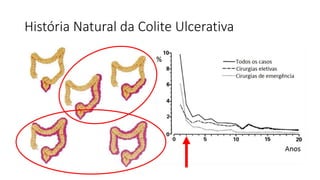 História Natural da Colite Ulcerativa
 