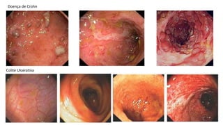 Colite Ulcerativa
Doença de Crohn
 