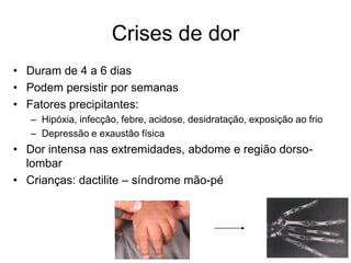 Crises de dor
• Duram de 4 a 6 dias
• Podem persistir por semanas
• Fatores precipitantes:
   – Hipóxia, infecção, febre, acidose, desidratação, exposição ao frio
   – Depressão e exaustão física
• Dor intensa nas extremidades, abdome e região dorso-
  lombar
• Crianças: dactilite – síndrome mão-pé
 