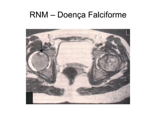 RNM – Doença Falciforme
 