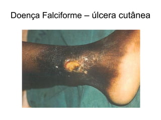 Doença Falciforme – úlcera cutânea
 