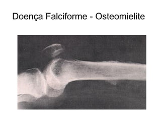 Doença Falciforme - Osteomielite
 