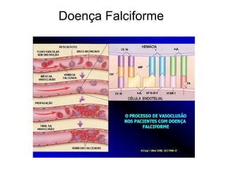 Doença Falciforme
 