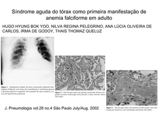 Síndrome aguda do tórax como primeira manifestação de
                anemia falciforme em adulto
HUGO HYUNG BOK YOO, NILVA REGINA PELEGRINO, ANA LÚCIA OLIVEIRA DE
CARLOS, IRMA DE GODOY, THAIS THOMAZ QUELUZ




J. Pneumologia vol.28 no.4 São Paulo July/Aug. 2002
 