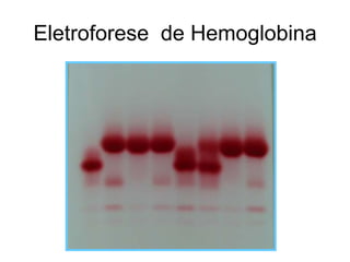 Eletroforese de Hemoglobina
 