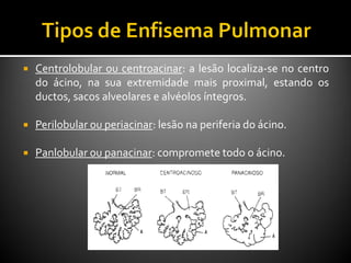  Centrolobular ou centroacinar: a lesão localiza-se no centro
do ácino, na sua extremidade mais proximal, estando os
ductos, sacos alveolares e alvéolos íntegros.
 Perilobular ou periacinar: lesão na periferia do ácino.
 Panlobular ou panacinar: compromete todo o ácino.
 