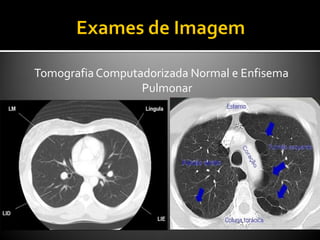 TomografiaComputadorizada Normal e Enfisema
Pulmonar
 