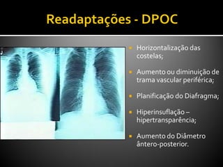 Horizontalização das
costelas;
 Aumento ou diminuição de
trama vascular periférica;
 Planificação do Diafragma;
 Hiperinsuflação –
hipertransparência;
 Aumento do Diâmetro
ântero-posterior.
 