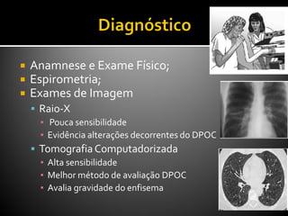  Anamnese e Exame Físico;
 Espirometria;
 Exames de Imagem
 Raio-X
▪ Pouca sensibilidade
▪ Evidência alterações decorrentes do DPOC
 Tomografia Computadorizada
▪ Alta sensibilidade
▪ Melhor método de avaliação DPOC
▪ Avalia gravidade do enfisema
 