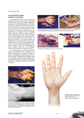TENOSSINOVECTOMIA
VENTRAL DO PUNHO
A tenossinovite volar no punho não é tão
evidente quanto a dorsal, pois o ligamento
transverso do carpo não permite a palpação
do tecido sinovial hiperplasiado e, pela mes-
ma razão, o aumento de volume não é tão
notado. A sinovite no canal do carpo causa
uma síndrome de compressão do nervo
mediano, caracterizada clinicamente por
hipoestesia na região ventral do polegar,
dedos indicador, médio e metade radial do
anular, associada a algum grau de paresia
dos músculos abdutor curto, oponente e fle-
xor curto do polegar. No exame clínico, os
testes de Phalen e Tinel são positivos. O
diagnóstico da sinovite volar do punho deve
ser precoce e, a ausência de resposta clíni-
ca com o tratamento medicamentoso, asso-
ciada a sinais clínicos de compressão do
nervo mediano, deve ser uma indicação
para tenossinovectomia cirúrgica precoce.
A via de acesso inclui uma incisão retilínea
entre as eminências tenar e hipotenar, cru-
zando oblíquamente a prega de flexão do
punho, e progredindo proximalmente de for-
ma curvilínea. O retináculo dos flexores deve
ser seccionado próximo à sua inserção ulnar.
A sinovectomia deve ser ampla, a hemostasia
rigorosa e a drenagem utilizada por cerca de
1 a 2 dias.
11
DOENÇA REUMATÓIDE
Tenosinovite exuberante ao nível do canal do carpo (zona
IV) com grave compressão do nervo mediano. Paciente
apresentava grave comprometimento da função da mão.
Observar aspecto após a secção do ligamento transverso
do carpo e tenosinovectomia.
Tenosinovite dos flexores do dedo mínimo, desde o canal de Guyon até o túnel osteofibroso. O
paciente apresentava sintomas de compressão do nervo ulnar no canal de Guyon.
Tenosinovite hemorrágica dos flexores ao nível do punho.
Esquema da técnica cirúrgica para
tenosinovectomia dos flexores do
canal do carpo (zona IV).
(veja seqüência das ilustrações)
 