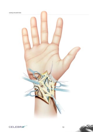 13
DOENÇA REUMATÓIDE
 