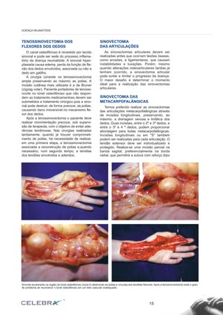 TENOSSINOVECTOMIA DOS
FLEXORES DOS DEDOS
O canal osteofibroso é revestido por tecido
sinovial e pode ser sede do processo inflama-
tório da doença reumatóide. A sinovial hiper-
plasiada causa edema, perda da função de fle-
xão dos dedos envolvidos, associada ou não a
dedo em gatilho.
A cirurgia consiste na tenossinovectomia
ampla preservando ao máximo as polias. A
incisão cutânea mais utilizada é a de Bruner
(zigzag volar). Paciente portadores de tenossi-
novite no túnel osteofibroso que não respon-
dem ao tratamento medicamentoso devem ser
submetidos a tratamento cirúrgico pois a sino-
vial pode destruir, de forma precoce, as polias,
causando dano irreversível no mecanismo fle-
xor dos dedos.
Após a tenossinovectomia o paciente deve
realizar movimentação precoce, sob supervi-
são de terapeuta, com o objetivo de evitar ade-
rências tendinosas. Nas cirurgias realizadas
tardiamente, quando já houver comprometi-
mento de polias, há necessidade de realizar,
em uma primeira etapa, a tenossinovectomia
associada a reconstrução de polias e,quando
necessário, num segundo tempo, a tenólise
dos tendões envolvidos e aderidos.
SINOVECTOMIA
DAS ARTICULAÇÕES
As sinovectomias articulares devem ser
realizadas antes que ocorram lesões ósseas,
como erosões, e ligamentares, que causam
instabilidades e luxações. Porém, mesmo
quando alterações osteoarticulares tardias já
tenham ocorrido, a sinovectomia articular
pode evitar e limitar o progresso da doença.
O maior desafio é determinar o momento
ideal para a realização das sinovectomias
articulares.
SINOVECTOMIA DAS
METACARPOFALÂNGICAS
Temos preferido realizar as sinovectomias
das articulações metacarpofalângicas através
de incisões longitudinais, preservando, ao
máximo, a drenagem venosa e linfática dos
dedos. Duas incisões, entre o 2º e 3º dedos, e
entre o 3º e 4 º dedos, podem proporcionar
abordagem para todas metacarpofalângicas.
Incisões longitudinais ou em "S" também
podem ser realizadas para cada articulação. O
tendão extensor deve ser individualizado e
protegido. Realiza-se uma incisão parcial na
banda sagital, preferencialmente na borda
radial, que permitirá a sutura com reforço (tipo
15
DOENÇA REUMATÓIDE
Sinovite exuberante na região do túnel osteofibroso (zona II) destruindo as polias e vinculas dos tendões flexores. Após a tenosinovectomia resta o gran-
de problema de reconstruir o túnel osteofibroso em um leito vascular inadequado.
 