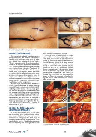 SINOVECTOMIA DO PUNHO
Normalmente é realizada associadamente a
tenossinovectomia dos tendões extensores e
da articulação rádio-ulnar distal. A via de aces-
so é dorsal, com incisões curvilíneas ou em
"S", e a cápsula articular é seccionada obser-
vando-se a anatomia ligamentar (incisão em
"V"). Todo tecido sinovial patológico é removido
e as erosões ósseas curetadas. A indicação de
sinovectomia do punho não é tão freqüente,
sendo mais usual agir no punho realizando
artrodeses segmentares ou totais. Observa-se,
precocemente, que há desarranjo nos ossos do
carpo, provocado por lesões ligamentares, na
maioria das vezes do padrão VISI ("volar inter-
caled segment instability"), responsáveis por
quadro degenerativo progressivo.
Na articulação rádio-ulnar distal, a cápsula é
aberta longitudinalmente e, se houver integrida-
de da cartilagem articular, associada a estabili-
dade ligamentar, a sinovectomia ampla pode
ser realizada e o prognóstico da evolução deve
ser favorável. Se houver comprometimento arti-
cular e instabilidade ou luxação, outros procedi-
mentos podem ser indicados como: ressecção
da cabeça da ulna, artroplastia de hemirresec-
ção e interposição (Bower’s), cirurgia de Sauvé
Kapandgi (ressecção da segmentar da ulna
com artrodese rádio-ulnar distal) e cirurgias de
estabilização da ulna.
EXCISÃO DA CABEÇA DA ULNA
(CIRURGIA DE DARRASH)
A cirurgia é indicada quando houver perda
da congruência entre o rádio distal e a ulna,
associada a lesão da cartilagem articular. A
ressecção da cabeça da ulna trará alívio da
sintomatologia dolorosa e melhora da movi-
mentação do punho. Estará indicada quando
houver desarranjo na articulação rádio-ulnar
distal e estabilidade na rádio-carpica.
Utiliza-se uma incisão dorsal curvilínea
ou em "S", ao nível da articulação rádio-
ulnar distal, individualiza-se o ramo sensitivo
dorsal do nervo ulnar e os tendões ulnar do
carpo e extensor próprio do 5º dedo, abre-se
a cápsula articular longitudinalmente e
expõe-se a cabeça da ulna. Realiza-se uma
osteotomia ao nível do colo da ulna, toman-
do-se o cuidado para não ressecar tecido
ósseo em excesso, o que pode causar uma
instabilidade indesejável. As espículas
ósseas são removidas por saca-bocados,
goivas ou fresas, e a cápsula suturada com
alguma tensão para conferir maior estabili-
dade à ulna distal.
17
DOENÇA REUMATÓIDE
Sinovectomia da articulação interfalangiana proximal.
Cirurgia de Darrash – ressecção da cabeça da ulna
 