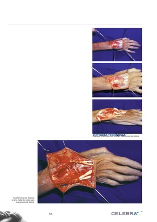 RUPTURAS TENDINOSAS
18
Rupturas tendinosas dos tendões extensores dos dedos.
Transferência dos flexores
ulnar e radial do carpo para
extensores dos dedos.
 