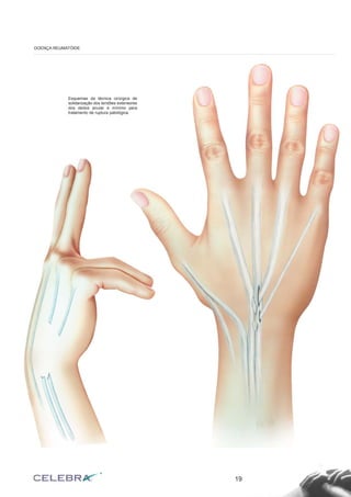 19
DOENÇA REUMATÓIDE
Esquemas da técnica cirúrgica de
solidarização dos tendões extensores
dos dedos anular e mínimo para
tratamento de ruptura patológica.
 
