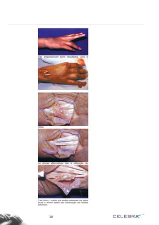 Outra implicação grave da doença reuma-
tóide é a ruptura patológica dos tendões. As
rupturas ocorrem com maior freqüência nos
tendões extensores e ao nível dos retináculos.
As rupturas podem ocorrer com ou sem trau-
ma. Como o tendão é patológico, as suturas
não proporcionam bons resultados, pois a
cicatrização não se processa de forma ade-
quada (comprometimento da vascularização).
Da mesma forma, os enxertos tendinosos não
são utilizados pois o leito receptor está com-
prometido e as aderências, em geral, são fre-
qüentes e de grande magnitude, impedindo o
retorno funcional adequado.
RUPTURA DOS EXTENSORES DOS
DEDOS
Após o extensor longo do polegar são os
tendões que mais freqüentemente se rompem
da doença reumatóide, principalmente os do 4º
e 5º dedos, incluindo o extensor próprio do 5º
dedo.
Nas rupturas dos extensores dos dedos
ulnares, o coto distal destes pode ser sutura-
do, com tensão adequada, nos tendões exten-
sores dos dedos radiais íntegros. Este é o pro-
cedimento mais freqüentemente utilizado e
proporciona bom resultado funcional.
Nas rupturas de todos tendões extensores
as únicas alternativas são a utilização de
enxerto de tendão ou a transferência tendinosa
(flexores radial e ulnar do carpo e outros) para
os extensores dos dedos. Os flexores do cor-
po são utilizadas, particularmente, quando
houver comprometimento da movimentação
do punho, ou quando houver indicação de
artrodese deste.
20
Caso clínico – ruptura dos tendões extensores dos dedos
anular e mínimo tratada pela solidarização dos tendões
extensores.
 