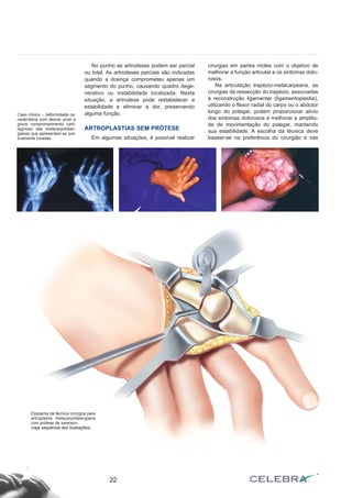 22
No punho as artrodeses podem ser parcial
ou total. As artrodeses parciais são indicadas
quando a doença comprometeu apenas um
segmento do punho, causando quadro dege-
nerativo ou instabilidade localizada. Nesta
situação, a artrodese pode restabelecer a
estabilidade e eliminar a dor, preservando
alguma função.
ARTROPLASTIAS SEM PRÓTESE
Em algumas situações, é possível realizar
cirurgias em partes moles com o objetivo de
melhorar a função articular e os sintomas dolo-
rosos.
Na articulação trapézio-metacarpeana, as
cirurgias de ressecção do trapézio, associadas
à reconstrução ligamentar (ligamentoplastia),
utilizando o flexor radial do carpo ou o abdutor
longo do polegar, podem proporcionar alívio
dos sintomas dolorosos e melhorar a amplitu-
de de movimentação do polegar, mantendo
sua estabilidade. A escolha da técnica deve
basear-se na preferência do cirurgião e nas
Caso clínico – deformidade ca-
racterística com desvio ulnar e
grave comprometimento carti-
laginoso das metacarpofalan-
gianas que apresentam-se pra-
ticamente luxadas.
Esquema da técnica cirúrgica para
artroplastia metacarpofalangiana
com prótese de swanson.
(veja seqüência das ilustrações)
 