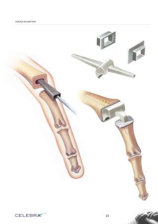 23
DOENÇA REUMATÓIDE
 