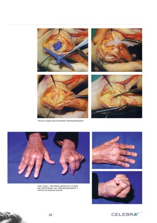 24
Técnica cirúrgica para artroplastia metacarpofalangiana.
Caso clínico – mão direita operada com correção
das deformidades nas metacarpofalangianas e
melhora da amplitude articular.
 