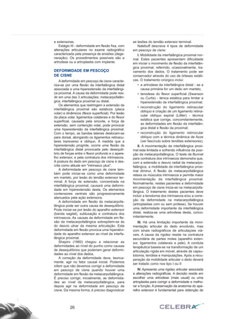 e extensoras.
Estágio III - deformidade em flexão fixa, com
alterações articulares no exame radiográfico
caracterizada pela presença de erosões (dege-
neração). Os procedimentos possíveis são a
artrodese ou a artroplastia com implante.
DEFORMIDADE EM PESCOÇO
DE CISNE
A deformidade em pescoço de cisne caracte-
riza-se por uma flexão da interfalângica distal
associada a uma hiperextensão da interfalângi-
ca proximal. A causa da deformidade pode resi-
dir em uma das 3 articulações: metacarpofalân-
gica, interfalângica proximal ou distal.
Os elementos que restringem a extensão da
interfalângica proximal são estáticos (placa
volar) e dinâmicos (flexor superficial). Por lesão
da placa volar, ligamentos colaterais e do flexor
superficial, causada pela sinovite, a força de
extensão, sem contenção volar, pode provocar
uma hiperextensão da interfalângica proximal.
Com o tempo, as bandas laterais deslocam-se
para dorsal, alongando os ligamentos retinacu-
lares transverso e oblíquo. À medida que a
hiperextensão progride, ocorre uma flexão da
interfalângica distal provocada pelo desequilí-
brio de forças entre o flexor profundo e o apare-
lho extensor, e pela contratura dos intrínsecos.
A postura do dedo em pescoço de cisne é des-
crita como atitude em "intrinseco plus".
A deformidade em pescoço de cisne tam-
bém pode iniciar-se como uma deformidade
em martelo, por lesão do tendão extensor ter-
minal. A força de extensão, concentrada na
interfalângica proximal, causará uma deformi-
dade em hiperextensão desta. Os elementos
contensores ventrais são progressivamente
atenuados pela ação extensora.
A deformidade em flexão da metacarpofa-
lângica pode ser outra causa de desequilíbrio.
Pode iniciar-se por lesão do aparelho extensor
(banda sagital), subluxação e contratura dos
intrínsecos. As causas da deformidade em fle-
xão da metacarpofalângica sobrepõem-se às
do desvio ulnar da mesma articulação. Esta
deformidade em flexão provoca uma hiperativi-
dade do aparelho extensor ao nível da interfa-
lângica proximal.
Shapiro (1960) chegou a relacionar as
deformidades ao nível do punho como causas
de desequilíbrios que poderiam gerar deformi-
dades ao nível dos dedos.
A correção da deformidade deve, teorica-
mente, agir no fator causal inicial. Podemos
inferir que não devemos corrigir a deformidade
em pescoço de cisne quando houver uma
deformidade em flexão da metacarpofalângica.
É preciso corrigir, inicialmente, as deformida-
des ao nível da metacarpofalângica, para
depois agir na deformidade em pescoço de
cisne. Da mesma forma, é preciso diagnosticar
as lesões do tendão extensor terminal.
Nalebuff descreve 4 tipos de deformidade
em pescoço de cisne:
I. Mobilidade da interfalângica proximal nor-
mal. Estes pacientes apresentam dificuldade
em iniciar o movimento de flexão da interfalân-
gica proximal, referindo, ocasionalmente, tra-
vamento dos dedos. O tratamento pode ser
conservador através do uso de órteses estáti-
cas. O tratamento cirúrgico inclui:
• a artrodese da interfalângica distal - se a
causa primária for um dedo em martelo;
• tenodese do flexor superficial (Swanson
ou Curtis) - ténica estática para limitar a
hiperextensão da interfalângica proximal;
• reconstrução do ligamento retinacular
oblíquo e criação de um ligamento retina-
cular oblíquo espiral (Littler) - técnica
estática que corrige, concomitantemente,
as deformidades em flexão da interfalân-
gica distal e flexão da proximal;
• reconstrução do ligamento retinocular
oblíquo com a técnica dinâmica de Azze
(ver fascículo sobre tendões extensores).
II. A movimentação da interfalângica proxi-
mal esta limitada e sofrendo influência da posi-
ção da metacarpofalângica. O teste de Bunnel
para contratura dos intrínsecos demonstra que,
com a extensão e desvio radial da metacarpo-
falângica, a mobilidade da interfalângica proxi-
mal diminui. A flexão da metacarpofalângica
relaxa os músculos intrínsecos e permite maior
movimentação da interfalângica proximal.
Normalmente, nestes pacientes a deformidade
em pescoço de cisne inicia-se na metacarpofa-
lângica. O tratamento destes pacientes deve
incluir a tenotomia dos intrínsecos e/ou a corre-
ção da deformidade na metacarpofalângica
(artroplastias com ou sem prótese). Se houver
uma deformidade importante da interfalângica
distal, realiza-se uma artrodese desta, conco-
mitantemente.
III. Há uma limitação importante da movi-
mentação articular do dedo envolvido, mas
com sinais radiográficos de articulaçoes viá-
veis. A causa da rigidez reside na contratura
secundária de partes moles (aparelho exten-
sor, ligamentos colaterais e pele). A conduta
terapêutica baseia-se na transformação de um
articulação rígida em móvel, através de capsu-
lotomia, tenólise e manipulações. Após a recu-
peração da mobilidade articular o dedo deverá
ser tratado como nos tipo I ou II
IV. Apresenta uma rigidez articular associada
a alterações radiográficas. A decisão reside em
escolher uma artrodese (mais usual) ou uma
artroplastia para corrigir a deformidade e melho-
rar a função. A preservação da anatomia do apa-
relho extensor é fundamental para obtenção de
26
 