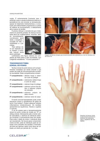 cação. É extremamente frustrante para o
paciente e para a equipe profissional observar a
persistência de uma sinovite ou tenossinovite,
apesar do tratamento medicamentoso, e a evo-
lução para deformidades progressivas ou perda
do sistema de funcionamento, e deslizamento
até a ruptura do tendão.
É preciso reforçar o conceito de que o trata-
mento do paciente portador de doença reuma-
tóide deve ser multidisciplinar, incluindo, além
do reumatologista,
coordenador geral
deste, o terapêuta, o
cirurgião de mão, o
ortopedista e o psi-
cólogo.
Todo esforço de-
ve ser realizado pa-
ra impedir a evolu-
ção natural desta
grave patologia.
Lembramos uma figura clássica do com-
pêndio de Platt sobre a mão reumatóide, com
a legenda ressaltando: "10 anos passaram !"
TENOSSINOVECTOMIA
DORSAL DO PUNHO
Na face dorsal do punho temos os 6 compar-
timentos revestidos por tecido sinovial e que
podem ser sede de uma tenossinovite na doen-
ça reumatóide. Estes compartimentos incluem:
1º compartimento – abdutor longo e exten-
sor curto do polegar
2º compartimento – extensores radiais longo
e curto do carpo
3º compartimento – extensor longo do polegar
4º compartimento – extensor comum dos de-
dos e extensor próprio
do indicador
5º compartimento – extensor próprio do
dedo mínimo
6º compartimento – extensor ulnar do carpo
O tecido sinovial hiperplasiado pode conter
pequenos corpos à semelhança de grãos de
arroz ("rice bodies"). Podem aparecer nódulos
inflamatórios intratendinosos. Os tendões
apresentam-se isquêmicos, friáveis e sujeitos
a rupturas.
A via de acesso para a tenossinovectomia
dorsal do punho consta de incisão em "S" ou
oblíqua dorsal, interessando pele e tecido celu-
lar subcutâneo, e abertura do retináculo exten-
sor envolvido. A sinovectomia deve ser ampla.
Para evitar o efeito de corda, o retináculo deve
ser reconstruído. Se houver grave comprometi-
mento do leito, parte do retináculo pode ser uti-
lizado como assoalho dos tendões. A hemosta-
sia deve ser rigorosa, assim como deve ser uti-
lizado um dreno por período de 1 a 2 dias.
5
DOENÇA REUMATÓIDE
Imagens da técnica cirúrgica para tenosinovectomia dos extensores ao nível do retináculo dor-
sal (zona VII).
Esquema da técnica cirúrgi-
ca para tenosinovectomia no
retináculo dos extensores.
(veja a seqüência das ilus-
trações)
 
