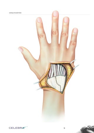 9
DOENÇA REUMATÓIDE
 