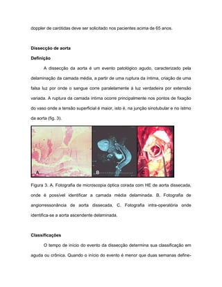 doppler de carótidas deve ser solicitado nos pacientes acima de 65 anos.
Dissecção de aorta
Definição
A dissecção da aorta é um evento patológico agudo, caracterizado pela
delaminação da camada média, a partir de uma ruptura da íntima, criação de uma
falsa luz por onde o sangue corre paralelamente à luz verdadeira por extensão
variada. A ruptura da camada íntima ocorre principalmente nos pontos de fixação
do vaso onde a tensão superficial é maior, isto é, na junção sinotubular e no ístmo
da aorta (fig. 3).
Figura 3. A. Fotografia de microscopia óptica corada com HE de aorta dissecada,
onde é possível identificar a camada média delaminada. B. Fotografia de
angiorressonância de aorta dissecada. C. Fotografia intra-operatória onde
identifica-se a aorta ascendente delaminada.
Classificações
O tempo de início do evento da dissecção determina sua classificação em
aguda ou crônica. Quando o início do evento é menor que duas semanas define-
 