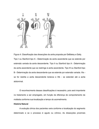 Figura 4. Classificação das dissecções da aorta proposta por DeBakey e Daily.
Tipo I ou Stanford tipo A - Delaminação da aorta ascendente que se estende por
extensão variada da aorta descendente. Tipo II ou Stanford tipo A - Delaminação
da aorta ascendente que se restringe à aorta ascendente. Tipo III ou Stanford tipo
B - Delaminação da aorta descendente que se estende por extensão variada. IIIa -
se for restrita a aorta descendente torácica e IIIb - se estender até a aorta
abdominal.
O reconhecimento dessas classificações é necessário, pois será importante
no tratamento a ser empregado, em função da diferença de comportamento da
moléstia conforme sua localização e tempo do acometimento.
História Natural
A evolução clínica dos pacientes varia conforme a localização do segmento
delaminado e se o processo é agudo ou crônico. As dissecções proximais
 