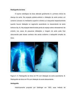 Radiografia de tórax
O exame radiológico do tórax alterado geralmente é o primeiro indício da
doença da aorta. Na projeção póstero-anterior a dilatação da aorta produz um
contorno convexo no mediastino superior à direita ou à esquerda respectivamente
quando houver dilatação no segmento ascendente ou descendente da aorta
torácica (fig. 6). Na projeção lateral existe perda do espaço aéreo retroesternal. No
entanto nos casos de pequenas dilatações a imagem da aorta pode ficar
obscurecida pela silueta cardíaca não sendo evidente a radiografia simples do
tórax.
Figura 6. A. Radiografia de tórax em PA com dilatação da aorta ascendente. B.
Radiografia de tórax em PA com dilatação da aorta descendente.
Aortografia
Historicamente proposto por Seldinger em 1953, esse método de
 