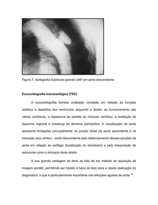 Figura 7. Aortografia ilustrando grande UAP em aorta descendente.
Ecocardiografia transesofágica (TEE)
A ecocardiografia fornece avaliação completa em relação às funções
sistólica e diastólica dos ventrículos esquerdo e direito, ao funcionamento das
valvas cardíacas, a espessura de parede do músculo cardíaco, a avaliação de
isquemia regional e presença de derrame pericárdico. A visualização da aorta
apresenta limitações principalmente na porção distal da aorta ascendente e na
transição arco aórtico - aorta descendente pelo distanciamento dessas porções da
aorta em relação ao esôfago (localização do transdutor) e pela interposição de
estruturas como o brônquio fonte direito.
A sua grande vantagem se deve ao fato de ser método de aquisição de
imagem portátil, permitindo ser trazido à beira do leito para a rápida realização do
diagnóstico, o que é particularmente importante nas afecções agudas da aorta 48
.
 