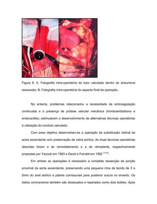 Figura 8. A. Fotografia intra-operatória do tubo valvulado dentro do aneurisma
ressecado. B. Fotografia intra-operatória do aspecto final da operação.
No entanto, problemas relacionados a necessidade de anticoagulação
continuada e a presença de prótese valvular mecânica (tromboembolismo e
endocardite), estimularam o desenvolvimento de alternativas técnicas operatórias
à utilização do conduto valvulado.
Com esse objetivo desenvolveu-se a operação da substituição radical da
aorta ascendente com preservação da valva aórtica. As duas técnicas operatórias
descritas foram a do remodelamento e a do reimplante, respectivamente
propostas por Yacoub em 1983 e David e Feindel em 1992 51,52
.
Em ambas as operações é necessário a completa ressecção da porção
proximal da aorta ascendente, preservando uma pequena rima de tecido de 3 a
5mm do anel aórtico e pilares comissurais para posterior sutura no enxerto. Os
óstios coronarianos também são dissecados e reparados como dois botões. Após
 