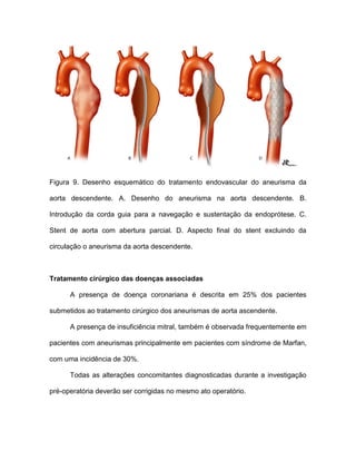 Figura 9. Desenho esquemático do tratamento endovascular do aneurisma da
aorta descendente. A. Desenho do aneurisma na aorta descendente. B.
Introdução da corda guia para a navegação e sustentação da endoprótese. C.
Stent de aorta com abertura parcial. D. Aspecto final do stent excluindo da
circulação o aneurisma da aorta descendente.
Tratamento cirúrgico das doenças associadas
A presença de doença coronariana é descrita em 25% dos pacientes
submetidos ao tratamento cirúrgico dos aneurismas de aorta ascendente.
A presença de insuficiência mitral, também é observada frequentemente em
pacientes com aneurismas principalmente em pacientes com síndrome de Marfan,
com uma incidência de 30%.
Todas as alterações concomitantes diagnosticadas durante a investigação
pré-operatória deverão ser corrigidas no mesmo ato operatório.
 