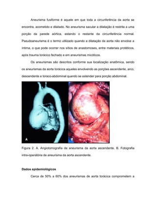 Aneurisma fusiforme é aquele em que toda a circunferência da aorta se
encontra, acometido e dilatado. No aneurisma sacular a dilatação é restrita a uma
porção da parede aórtica, estando o restante da circunferência normal.
Pseudoaneurisma é o termo utilizado quando a dilatação da aorta não envolve a
íntima, o que pode ocorrer nos sítios de anastomoses, entre materiais protéticos,
após trauma torácico fechado e em aneurismas micóticos.
Os aneurismas são descritos conforme sua localização anatômica, sendo
os aneurismas da aorta torácica aqueles envolvendo as porções ascendente, arco,
descendente e toraco-abdominal quando se estender para porção abdominal.
Figura 2. A. Angiotomografia de aneurisma da aorta ascendente. B. Fotografia
intra-operatória de aneurisma da aorta ascendente.
Dados epidemiológicos
Cerca de 50% a 60% dos aneurismas de aorta torácica comprometem a
 
