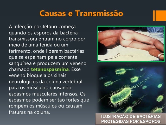 Tétano: Sintomas, Transmissão E Prevenção – EMXE
