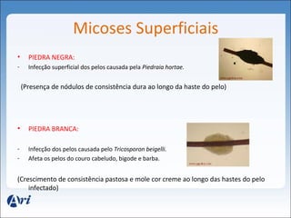 Micoses Superficiais 
• PIEDRA NEGRA: 
- Infecção superficial dos pelos causada pela Piedraia hortae. 
(Presença de nódulos de consistência dura ao longo da haste do pelo) 
• PIEDRA BRANCA: 
- Infecção dos pelos causada pelo Tricosporon beigelli. 
- Afeta os pelos do couro cabeludo, bigode e barba. 
(Crescimento de consistência pastosa e mole cor creme ao longo das hastes do pelo 
infectado) 
 