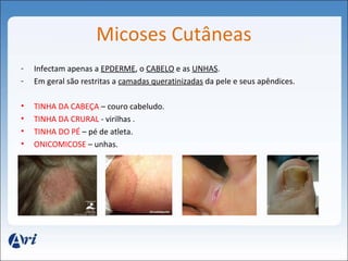 Micoses Cutâneas 
- Infectam apenas a EPDERME, o CABELO e as UNHAS. 
- Em geral são restritas a camadas queratinizadas da pele e seus apêndices. 
• TINHA DA CABEÇA – couro cabeludo. 
• TINHA DA CRURAL - virilhas . 
• TINHA DO PÉ – pé de atleta. 
• ONICOMICOSE – unhas. 
 