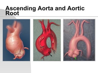 Doenças da aorta | PDF
