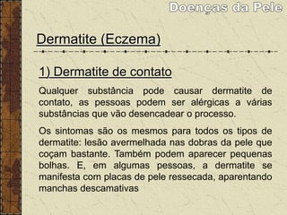 Dermatite (Eczema)
1) Dermatite de contato
Qualquer substância pode causar dermatite de
contato, as pessoas podem ser alérgicas a várias
substâncias que vão desencadear o processo.
Os sintomas são os mesmos para todos os tipos de
dermatite: lesão avermelhada nas dobras da pele que
coçam bastante. Também podem aparecer pequenas
bolhas. E, em algumas pessoas, a dermatite se
manifesta com placas de pele ressecada, aparentando
manchas descamativas
 