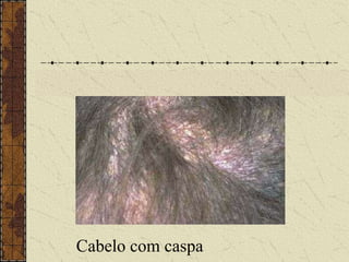 Cabelo com caspa
 