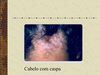 Cabelo com caspa
 