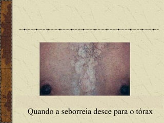 Quando a seborreia desce para o tórax
 